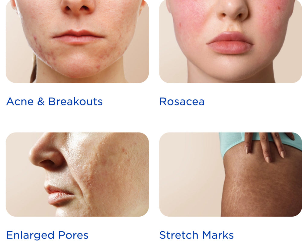 Microneedling - Too Good to Be Truth