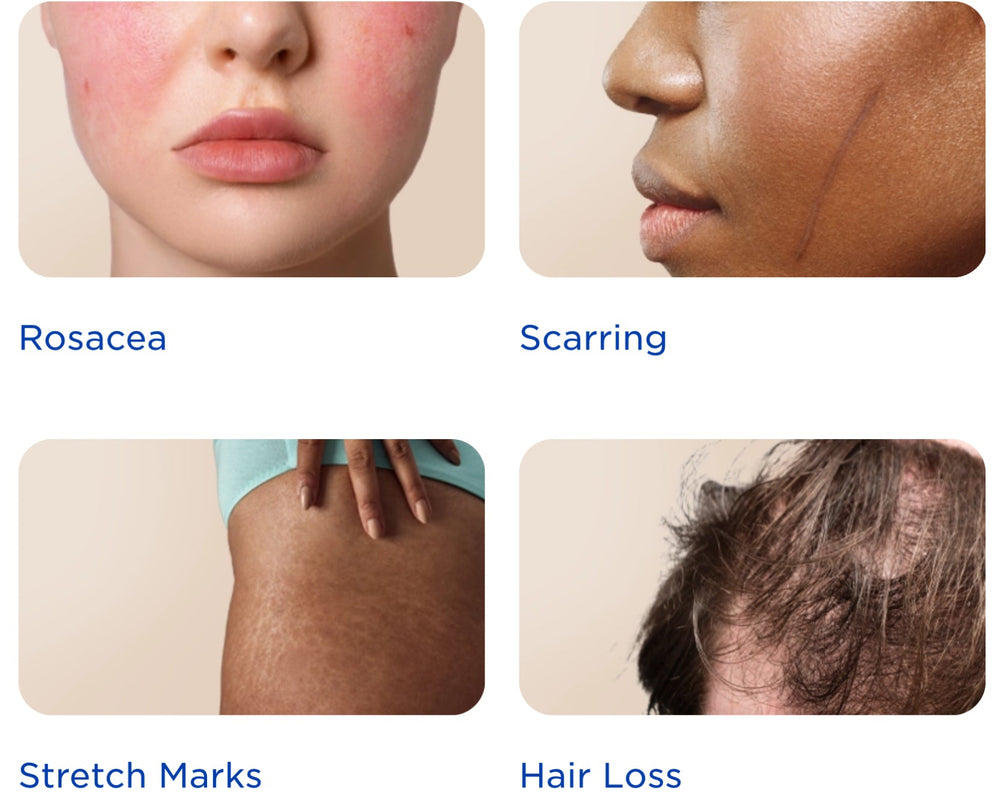 Microneedling - Too Good to Be Truth