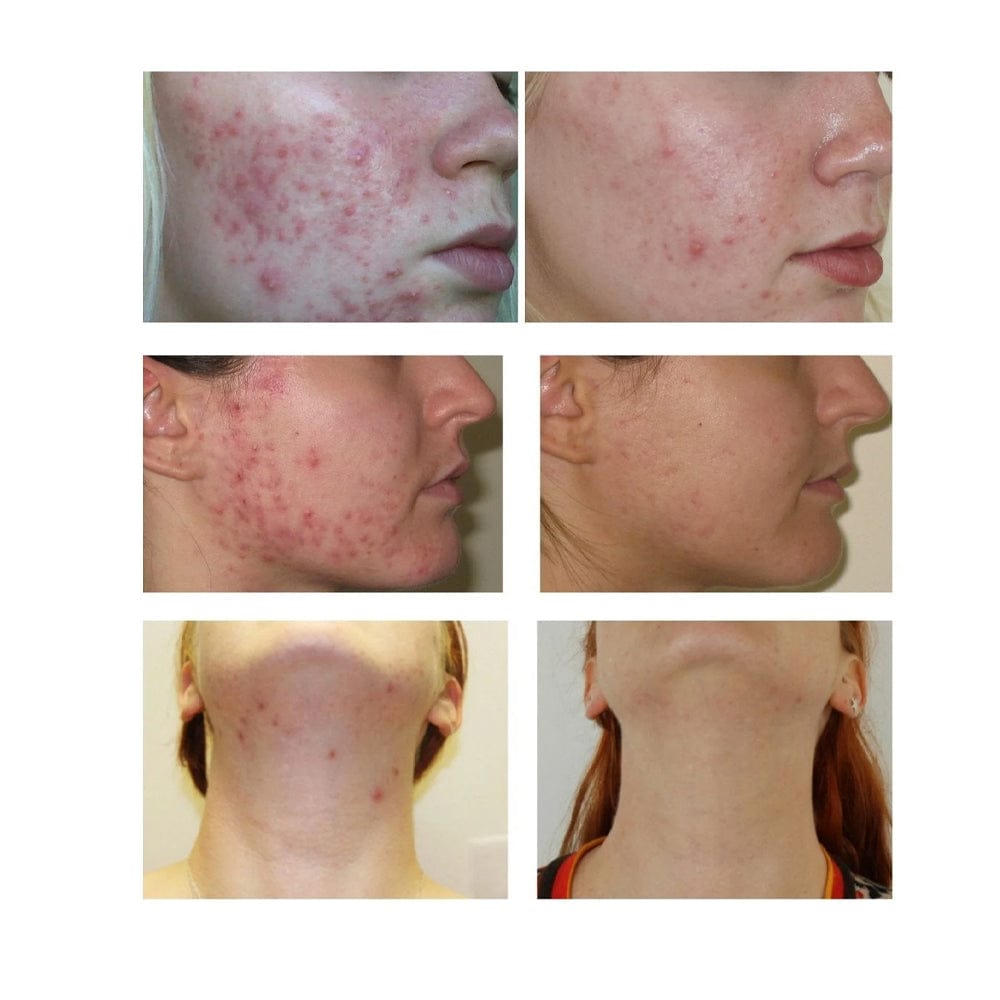 Skin Accumax™
